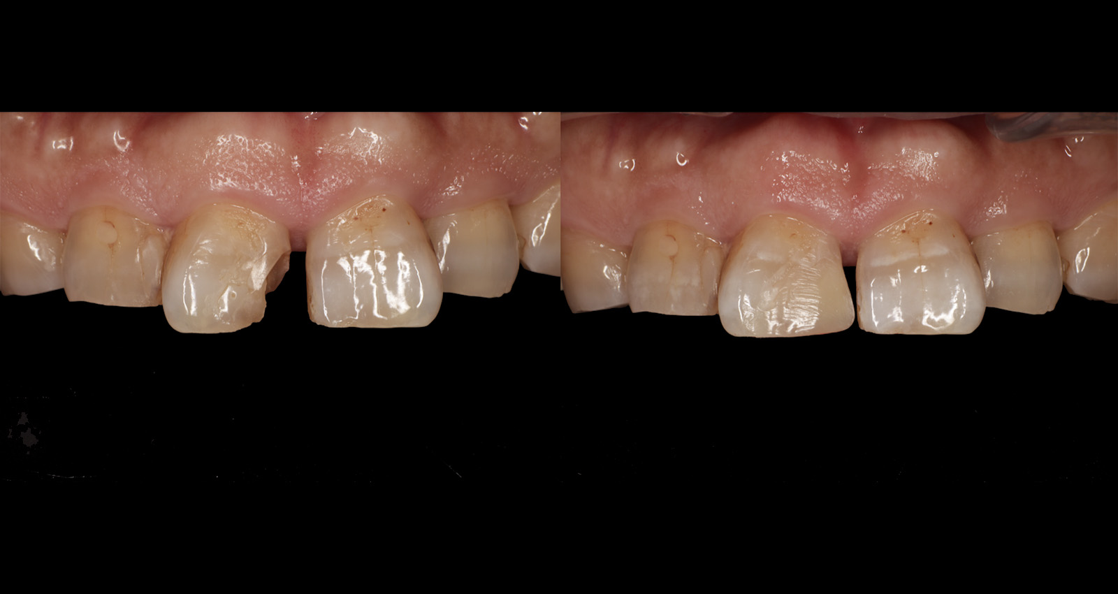 前歯の虫歯のダイレクトボンディング