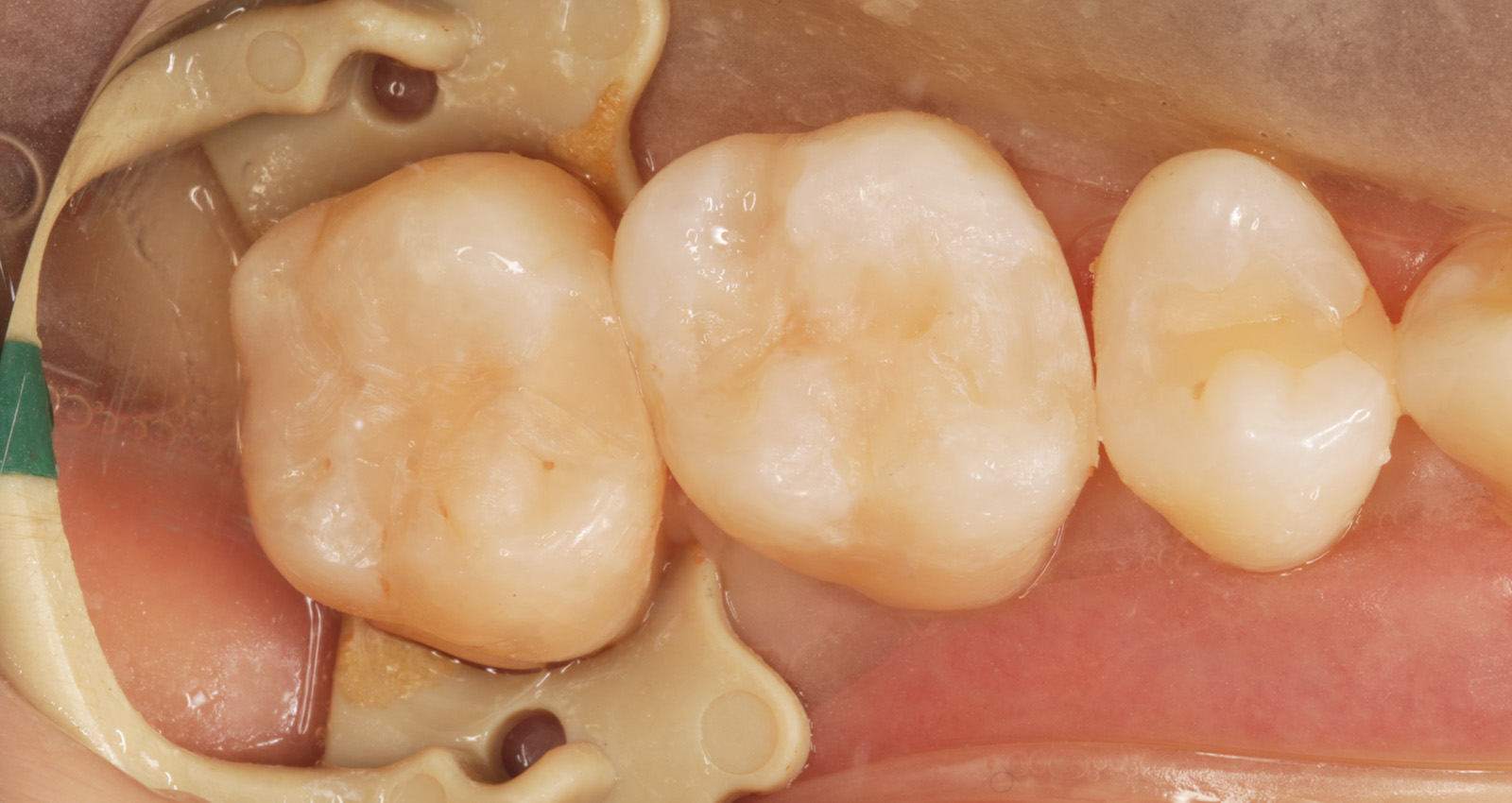 奥歯の虫歯のダイレクトボンディングについて