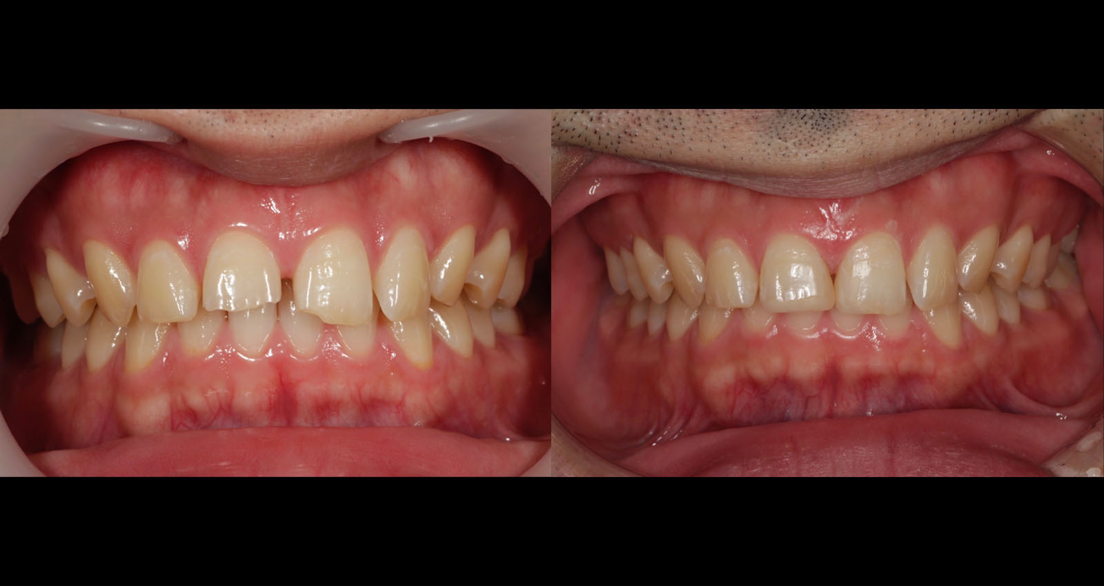 前歯のすきっ歯のダイレクトボンディングについて