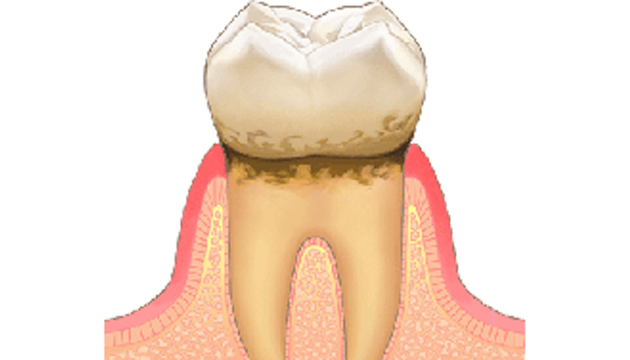 軽度歯周病について